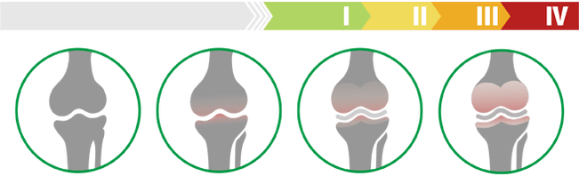 Estágios clínicos de artrose da articulação do joelho (grau de artrose da articulação do joelho)