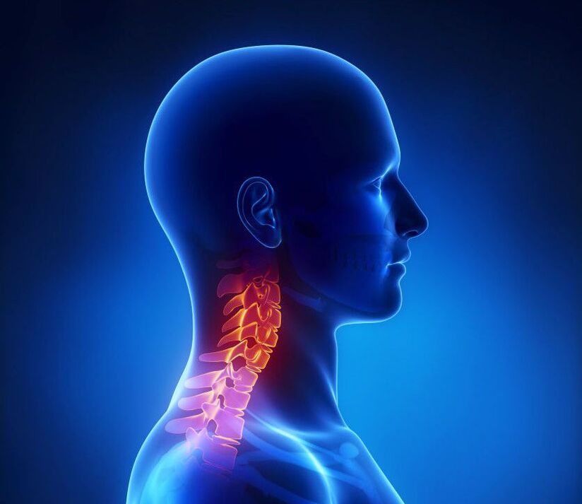 A osteocondrose cervical é uma patologia da coluna vertebral, da qual você pode se livrar em casa