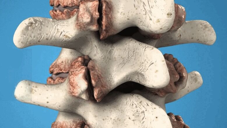osteófitos da coluna vertebral como causa de dor lombar