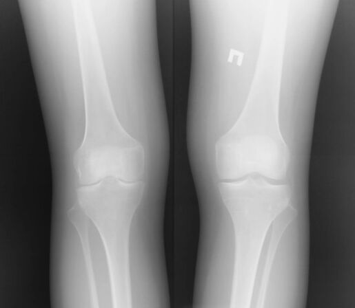 A radiografia da articulação do joelho