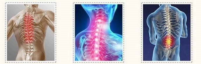 Lesões espinhais de osteocondrose