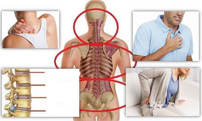 Locais de doença para osteocondrose
