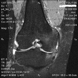 Osteoartrite da articulação do joelho na ressonância magnética