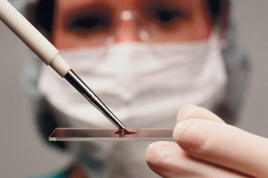 A artrite é uma doença inflamatória e sua presença é revelada por exames de sangue.
