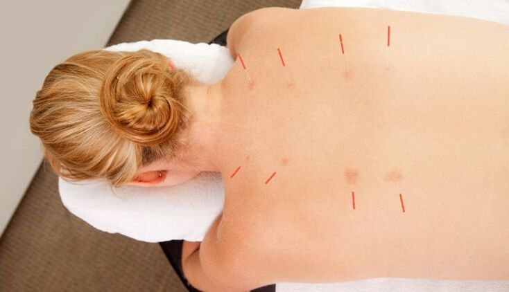 Acupuntura para osteocondrose torácica, que tem muitas vantagens